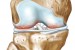 Arthrose-2